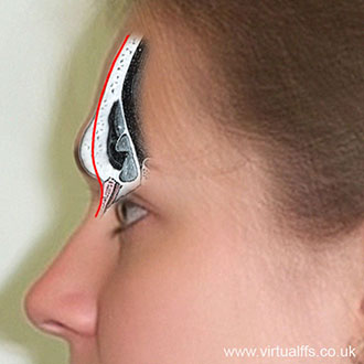 Virtual FFS: Forehead